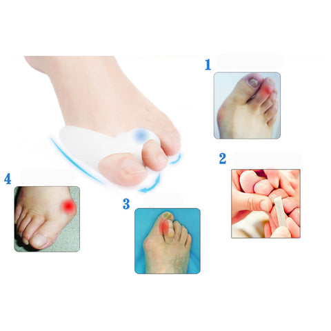 Corrector Beetle-Crusher Toes Outer Appliance Foot Care Products